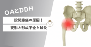 股関節OAと臼蓋形成不全の紹介